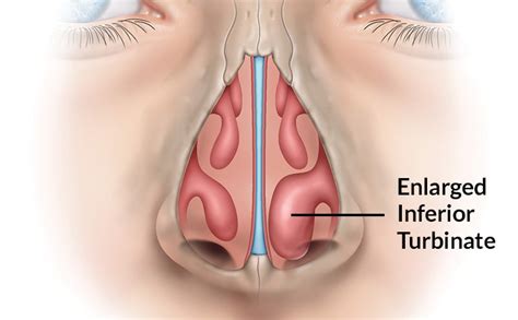 Turbinate Reduction St. Louis, MO | Turbinate Reduction Surgery