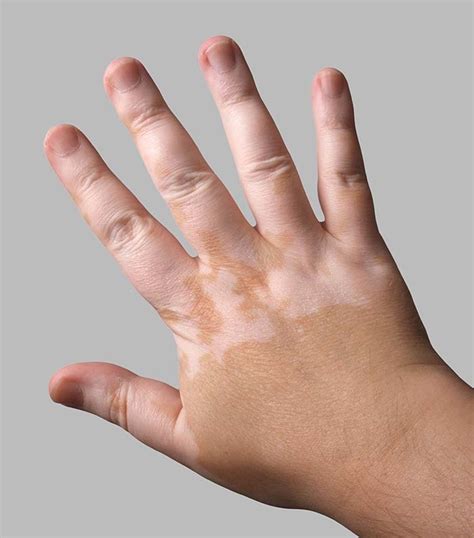 Vitiligo - symptoms, treatments and causes | healthdirect