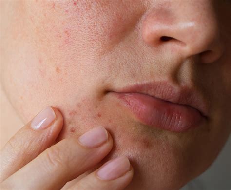 WHAT IS PERIORAL DERMATITIS? - Dr. Barbara Sturm - INTERNATIONAL