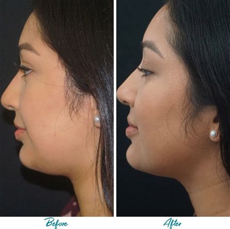 Patient 18616380 | Profound RF Skin Tightening Before & After Photos ...