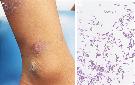 Cutaneous Diphtheria | NEJM