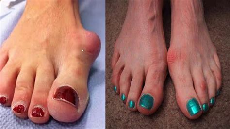 Is Bunion Surgery for Me? | Lake Mead Hospital