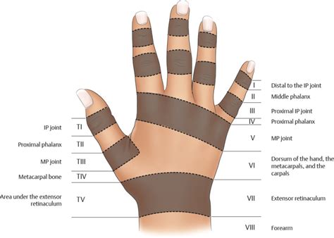 Zones Of Extensor Tendon Injury