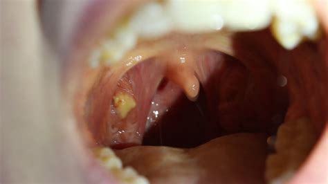 Tonsil Cancer Stages