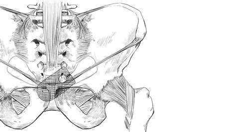 Hernia Mesh Implant Lawsuits - Complications and Injuries | McIntyre Law