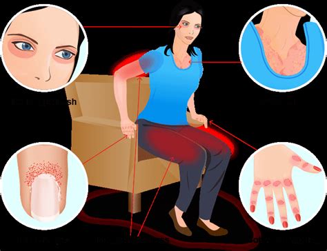 Dermatomyositis - Cause, Symptoms, Treatment - Mobile Physio