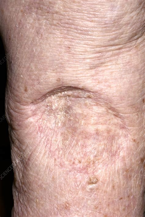 Scar after skin cancer removal - Stock Image - C028/4514 - Science ...