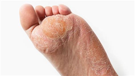 How to Get Rid of Hard Skin on Feet Quick | WalkJogRun