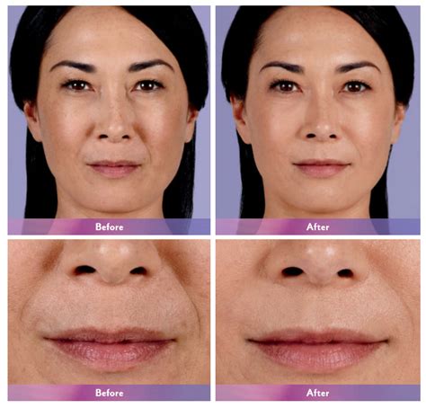 Secret Weapon to Fighting Signs of Aging: Dermal Fillers - Dy ...