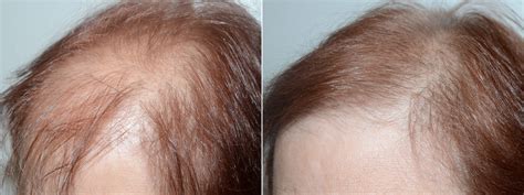 Hair Transplants for Women photos | Miami, FL | Patient74079