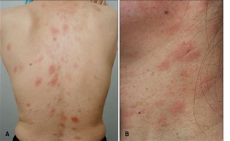 [PDF] Generalized Eczema-like Eruption in a Patient Treated with ...