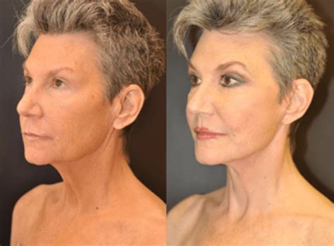 Mini-Facelift | Dr. Dean Kane | Baltimore, Maryland