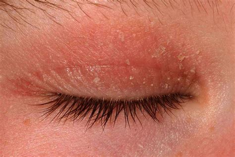 Skin Rash On Eyelid Eyelid Eyelids Rash Itchy Psoriasis Swollen Causes ...