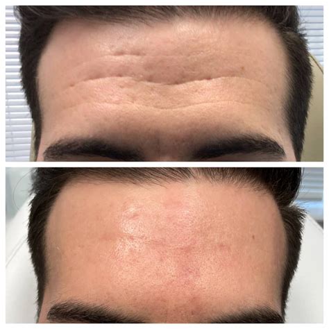 Forehead Wrinkles Before and After - St. Louis Dermatology & Cosmetic ...