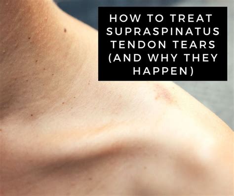 A Guide to Supraspinatus Tendon Tears (Rotator Cuff Injury) | Tendon ...