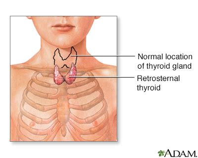 HIE Multimedia - Retrosternal thyroid surgery