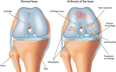 Chondral (lining damage) injury - Knee, Hip and Shoulder