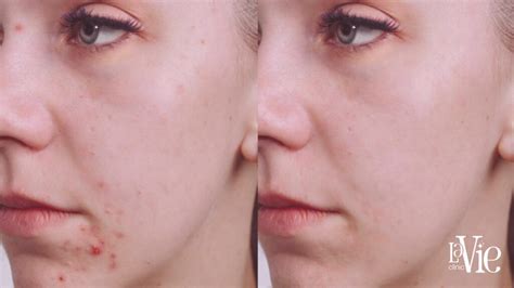 Why is BBL Scars Treatment the Best for Fading Acne Scars?