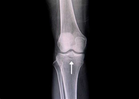 Tibial Eminence Fracture Repair | Complex Knee Surgeon | Vail, Aspen ...