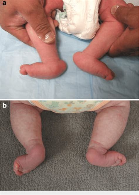 Figure 1 from Congenital Vertical Talus: An Updated Review | Semantic ...