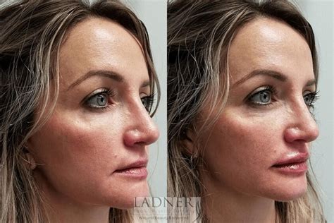 Dermal Fillers Before and After Pictures Case 76 | Denver, CO | Ladner ...