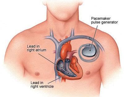 Pacemaker Implant Surgery Cost In India - Cost Of CRTD Implant Surgery ...