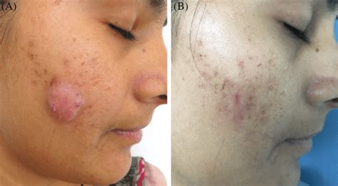 Cystic Acne: Causes, Treatment, Prevention — citiMuzik