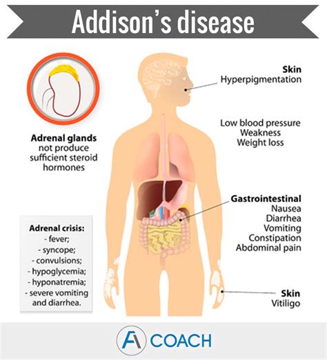 Adrenal Gland Disorders: A Quick Overview - Adrenal Fatigue Coach