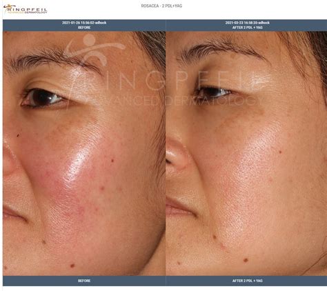 Rosacea Treatment Philadelphia & Main Line PA