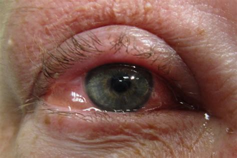 Allergische conjunctivitis: oorzaken, symptomen en preventie | Live ...