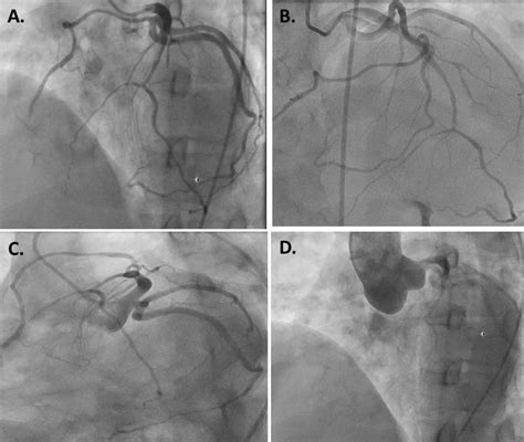 Interpretation of a coronary angiogram | Heart