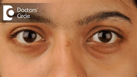 What Causes Dark Under Eyes - Infoupdate.org