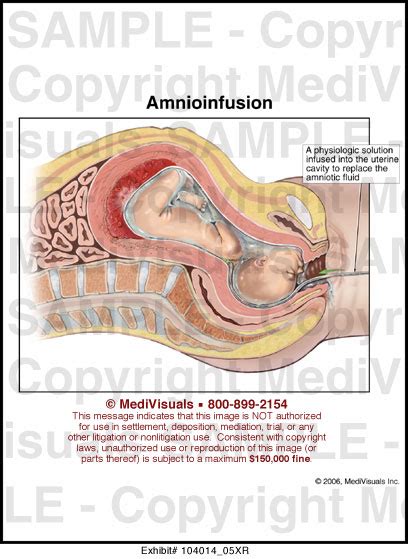 Amnioinfusion Medical Illustration Medivisuals