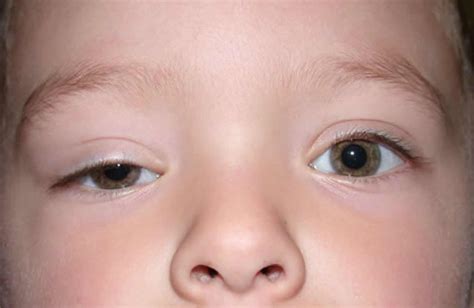 Ptosis, droopy eyelid causes, droopy eyelid treatment and ptosis surgery