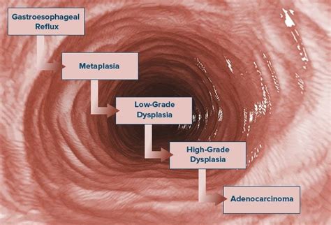 Staging Of Esophageal Cancer