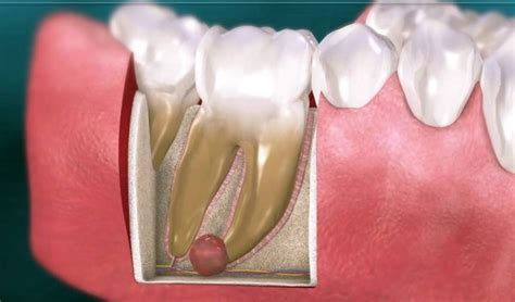 Dental Cyst | The Dental Arcade – Blog