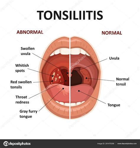 Tonsils and throat diseases. Tonsillitis symptoms. Anatomy of human ...