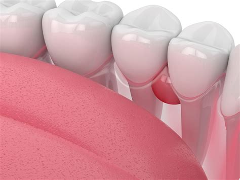 Gum Cysts | Causes, Symptoms and Treatment Options