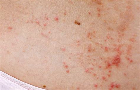 Heat Rash In Adults: Causes, Treatment, And Prevention Tips