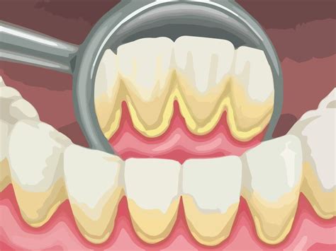 remove-dental-plaque-and-tartar-3 | Kuipers Ortho