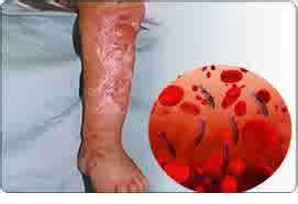 Septicemia: Symptoms, Complications and Diagnosis - Nursing Care Plan