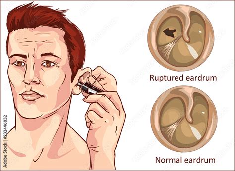 ruptured eardrum and normal eardrum vector illustration Stock Vector ...