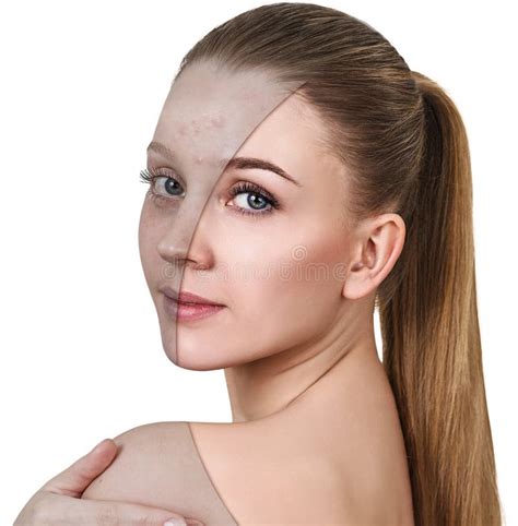 Young Woman with Acne before and after Treatment. Stock Image - Image ...