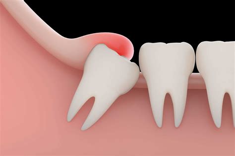 Are Canine Teeth The Most Painful