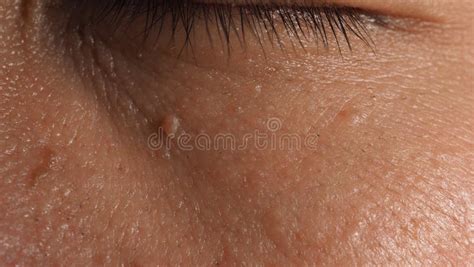 Wart on Face. Macro Shot of Wart Near Eye Stock Image - Image of benign ...