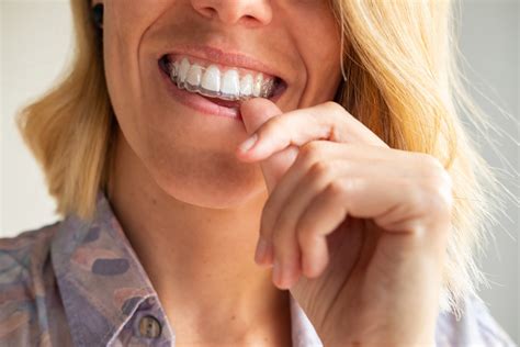 What You Should Know About Invisalign Attachments and Buttons