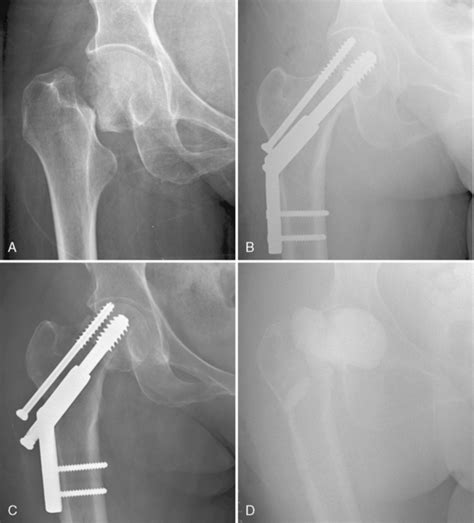 Femoral Neck Fracture Treatment