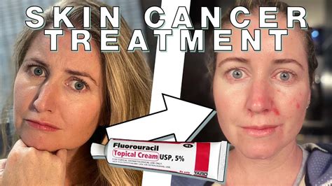 Chantelle's Fluorouracil Skin Cancer Treatment | Skin Deep - YouTube