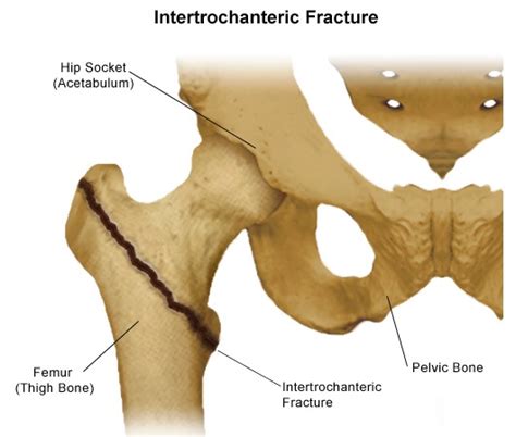 Left Femoral Neck Osteoporosis