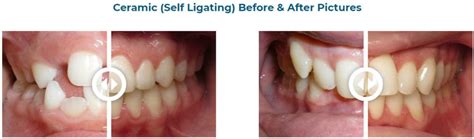 Clear Bracket Braces - Best Ceramic Braces Orthodontist in Temecula